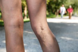 ivc filters lawsuits